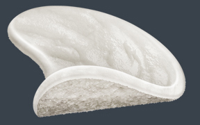 ALLIO fibrocartilage graft showing its smooth upper surface and rough underside