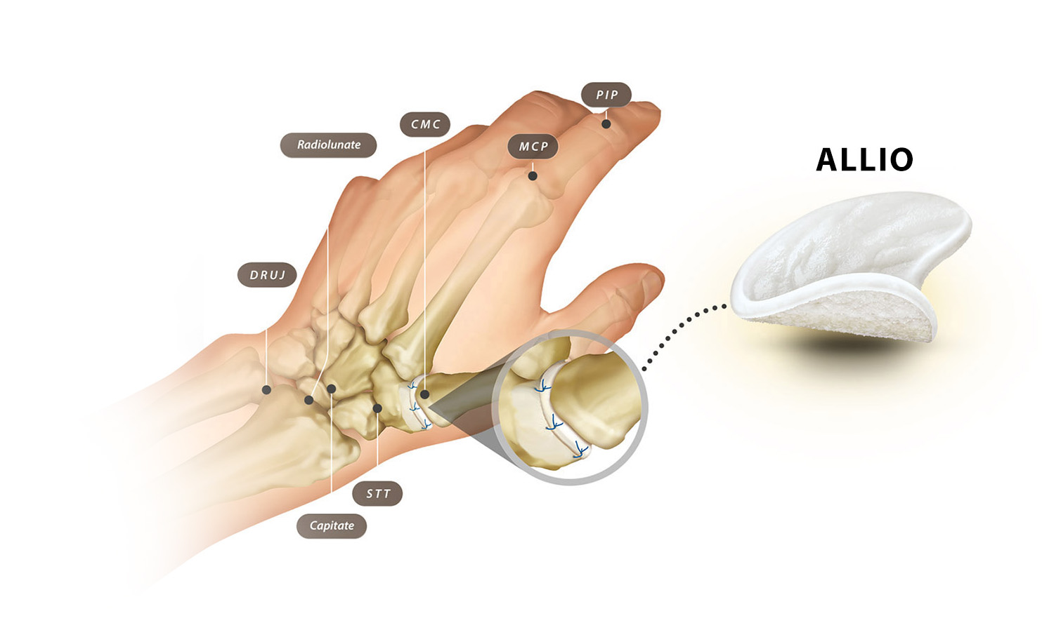 ALLIO™ device